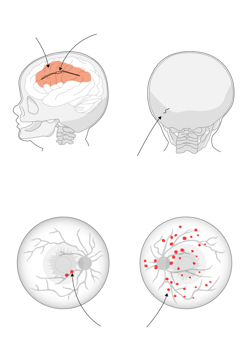 3. Back to the beginning: A child abuse pediatrician reviewed 5-month old Mason's injuries after the accident — two skull fractures, subdural bleeding and retinal hemorrhages — and flagged concerns. Short falls are often scary for parents, but they rarely result in serious harm.