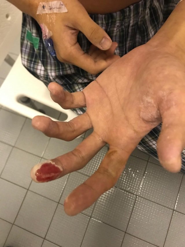 The wounded first-aider, suffering from 2nd-/3rd- degree burns by teargas, used to dream abt being a police officer, but #HKprotests made him realize #PoliceBrutality and completely changed his mind. Despite unremovable scar on his back, he had no regret rescuing ppl on frontline