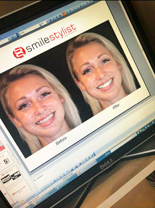 SmileStylistTO's tweet image. From #openbite to perfect bite
From - thesmilestylist.ca #beautiful to #gorgeous #smile