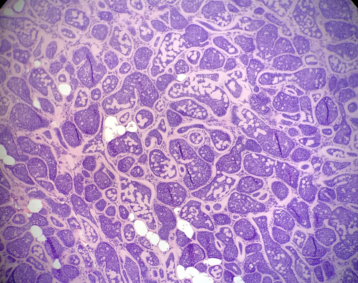 Аденокарцинома предстательной железы гистология. Гистология аденома карцинома. Острый гнойный пиелонефрит гистология. Ацинарная аденокарцинома простаты гистология. Гематоксилин краситель гистология.