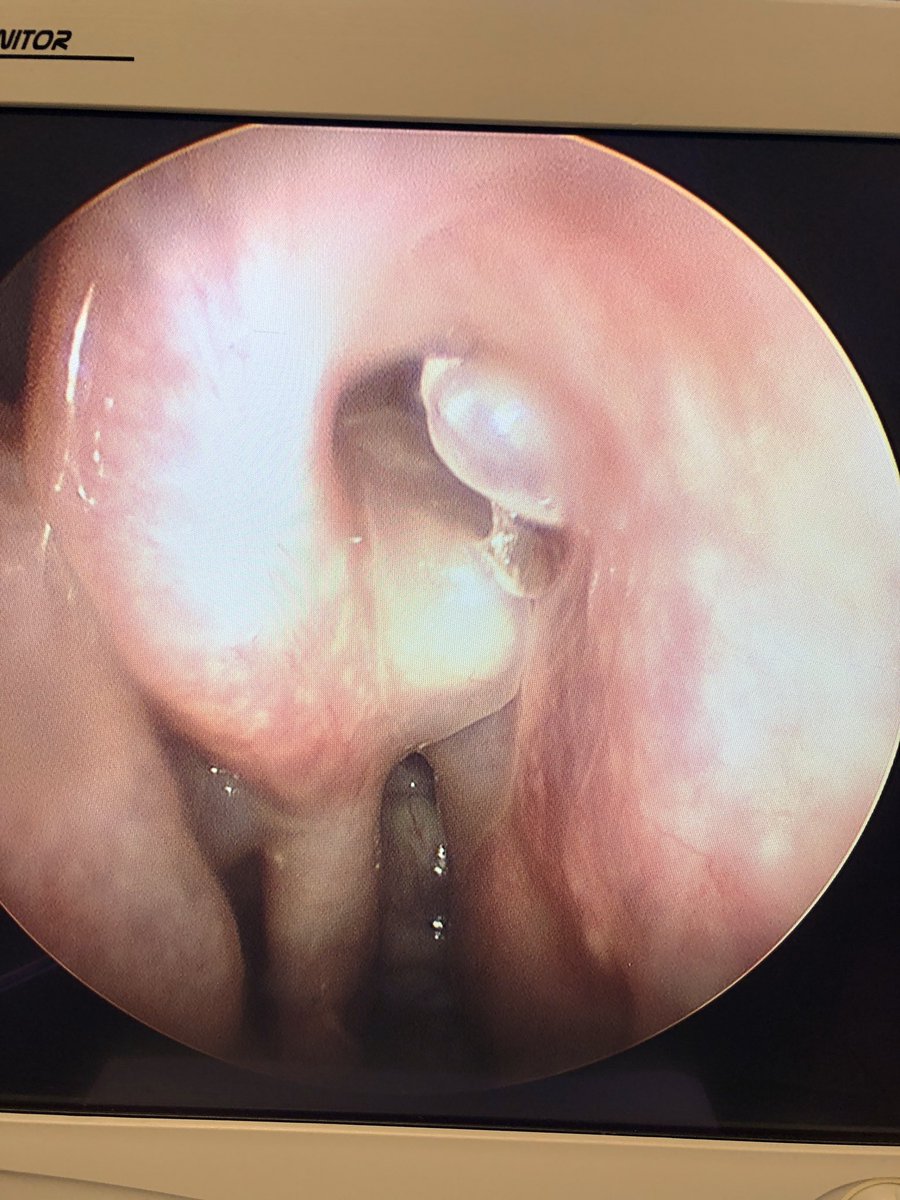 MyAllergyENT's tweet photo. #PeerToPeer training #COE day with @DrLeeBryant @DrScottFortune polypectomy #Latera #Clarifix septoplasty #ethmoidectomy &amp; #BalloonSinusDilation #minimallyinvasiverhinology #officebasedrhinology https://t.co/w6vdX9qhii
