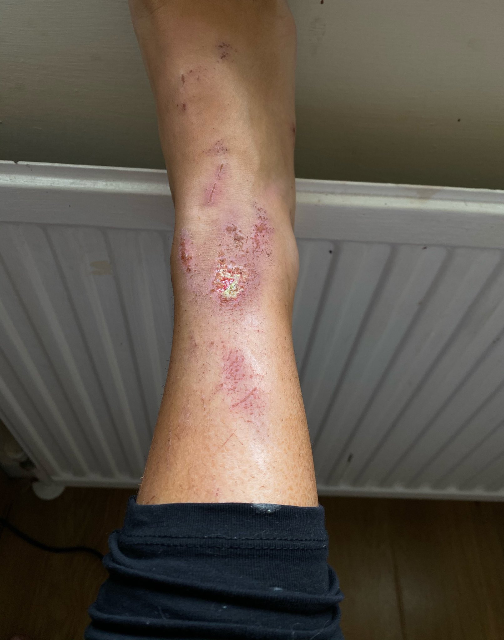 Eczema Legs Shaving
