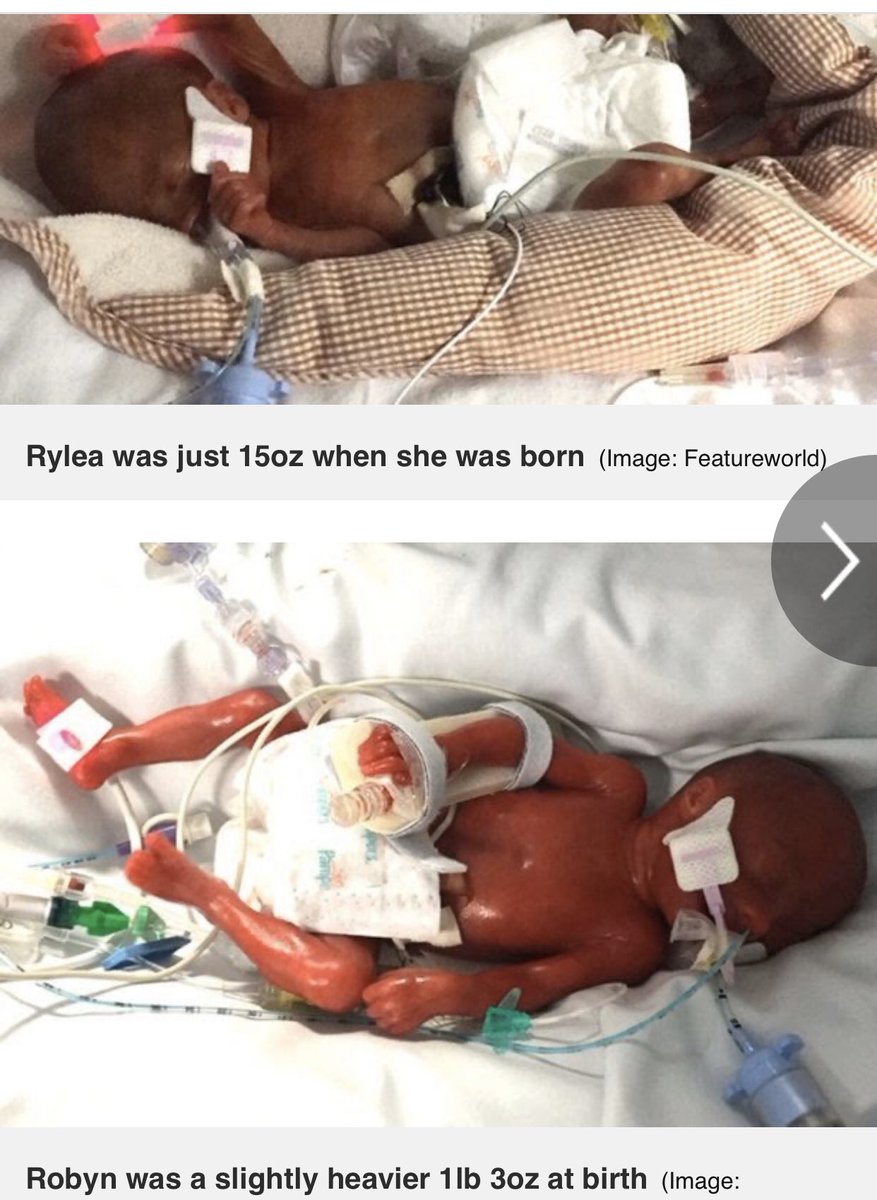 Rylea weighed 15oz at birth and Robyn weighed 1lb 3oz. They were born at 23 weeks and 3 days. They were given a 10% chance of survival but they’re healthy and meeting all of their milestones.  https://www.mirror.co.uk/news/uk-news/miracle-twins-tiniest-born-uk-8670997