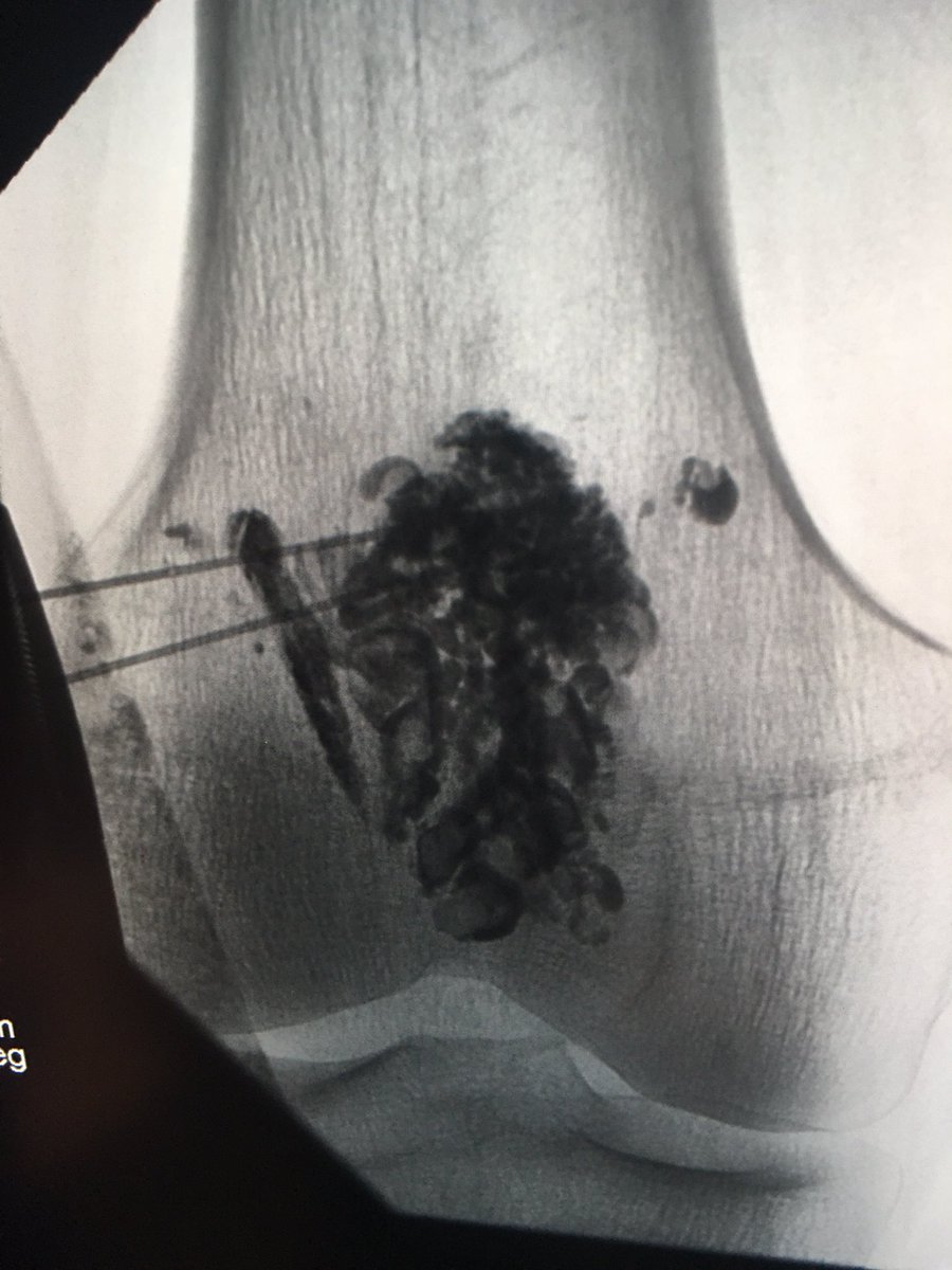 Direct stick venogram for venous malformation behind knee. Treated by with a venting needle and a mixture of alcohol and a little lipidiol. Thanks for the tips <a href="/FIRVAmeeting/">FIRVA</a> #vascmal #irad #iamrad #twittir <a href="/SIRspecialists/">Society of Interventional Radiology</a>