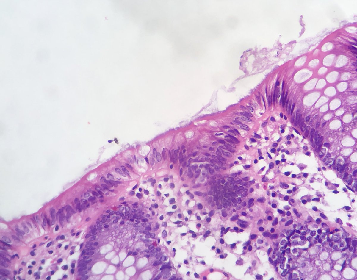 D4L14H's tweet image. Guess what?

#GITpath #pathology 
Last photo- sliver stain