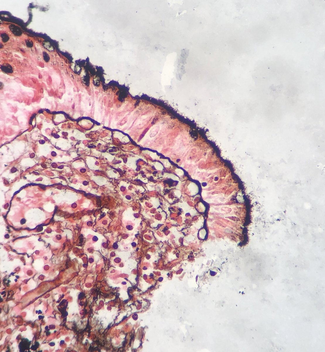 D4L14H's tweet image. Guess what?

#GITpath #pathology 
Last photo- sliver stain