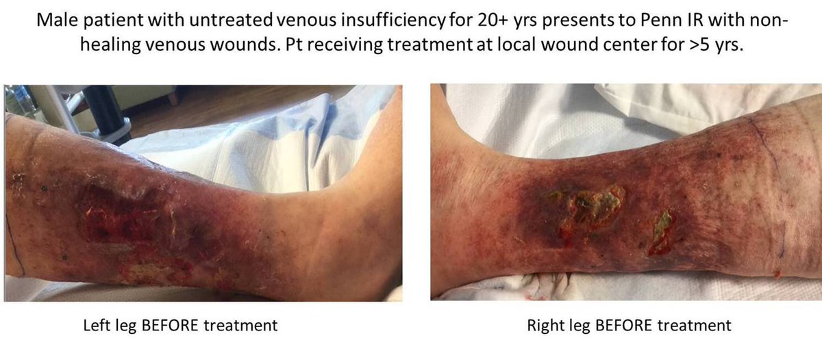 Deepak Sudheendra, MD, MHCI, RPVI, FSIR (@dr_sudi) on Twitter photo This is THE case that made me a believer in intravascular ultrasound!
Pt w/20y h/o untreated CVI getting constant #ulcer debridement at wound care center for 5 yrs. Poor #QOL.
<a href="/VEITHsymposium/">VEITHsymposium</a> <a href="/AIMsymposium/">AIMSymposium</a> <a href="/SIR_ECS/">SIR ECS</a> <a href="/SIRspecialists/">Society of Interventional Radiology</a> <a href="/VascularSVS/">Society for Vascular Surgery</a> <a href="/ACPinternists/">ACP</a> <a href="/aafp/">AAFP</a> <a href="/Healogics/">Healogics</a> This is THE case that made me a believer in intravascular ultrasound!
Pt w/20y h/o untreated CVI getting constant #ulcer debridement at wound care center for 5 yrs. Poor #QOL.
<a href="/VEITHsymposium/">VEITHsymposium</a> <a href="/AIMsymposium/">AIMSymposium</a> <a href="/SIR_ECS/">SIR ECS</a> <a href="/SIRspecialists/">Society of Interventional Radiology</a> <a href="/VascularSVS/">Society for Vascular Surgery</a> <a href="/ACPinternists/">ACP</a> <a href="/aafp/">AAFP</a> <a href="/Healogics/">Healogics</a>