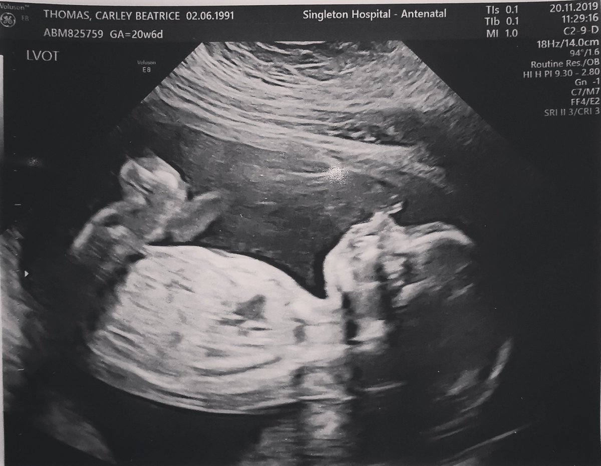 carleythomas_'s tweet image. 20 week scan, the last time we get to see this little one on the screen until he's born 💙 #20weekscan #babyboy