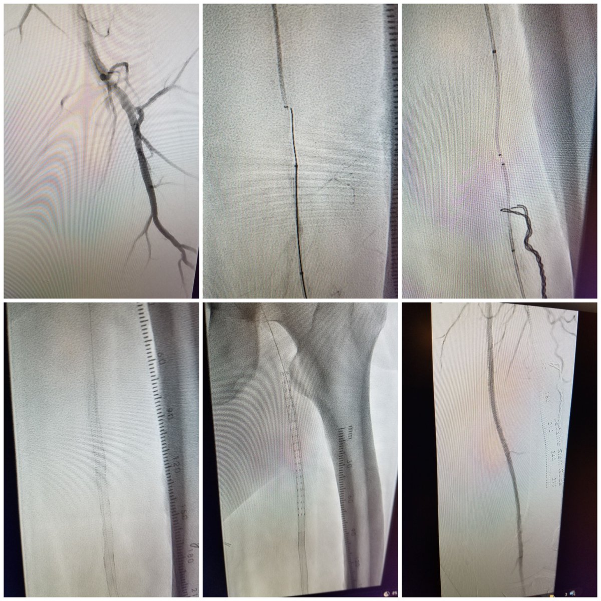 nucryo's tweet photo. Great PolarCath case today by @AliotaMD !  Crossing a very difficult lesion, placing two Supera stents (Abbott Vascular) and then post dilating the stents with 6x100 PolarCath (Cryoplasty) @nucryo . via the COBRA data (https://t.co/qGJquA4ie9). https://t.co/kuOyJeVrvq