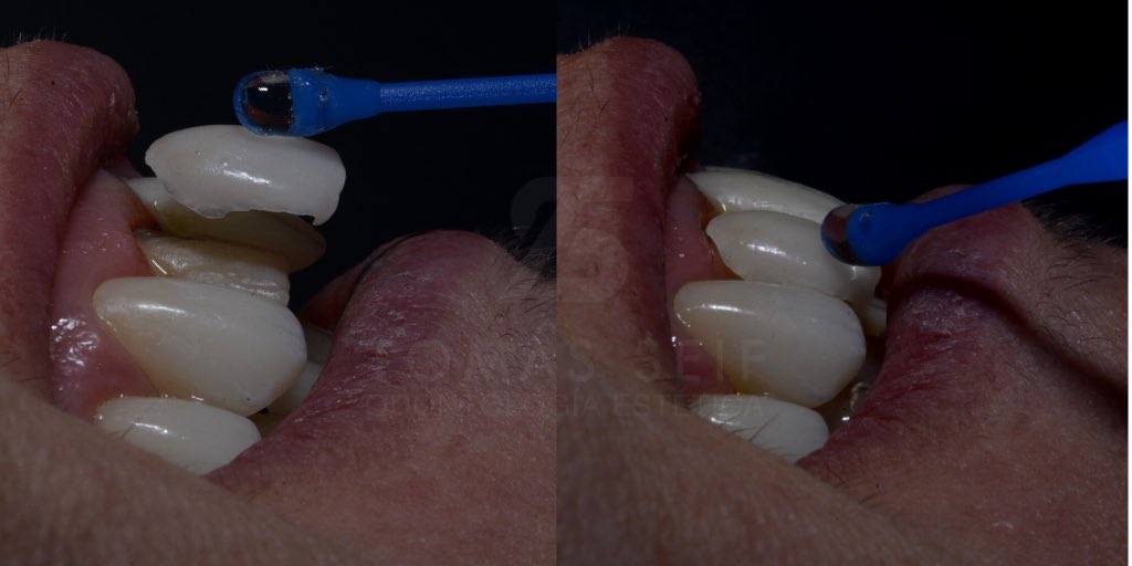 SonrisaSeif's tweet photo. ¿Te importa la experiencia? Entre muchos procedimientos que realizo, tengo mas de 900 CASOS de carillas dentales de diversas magnitudes en mis 27 años de ejercicio profesional como especialista.
#esteticadental #dientesano #dientesblancos #sonrisaexitosa #sonrisaseif #odontolover https://t.co/nK9A4rgpC9