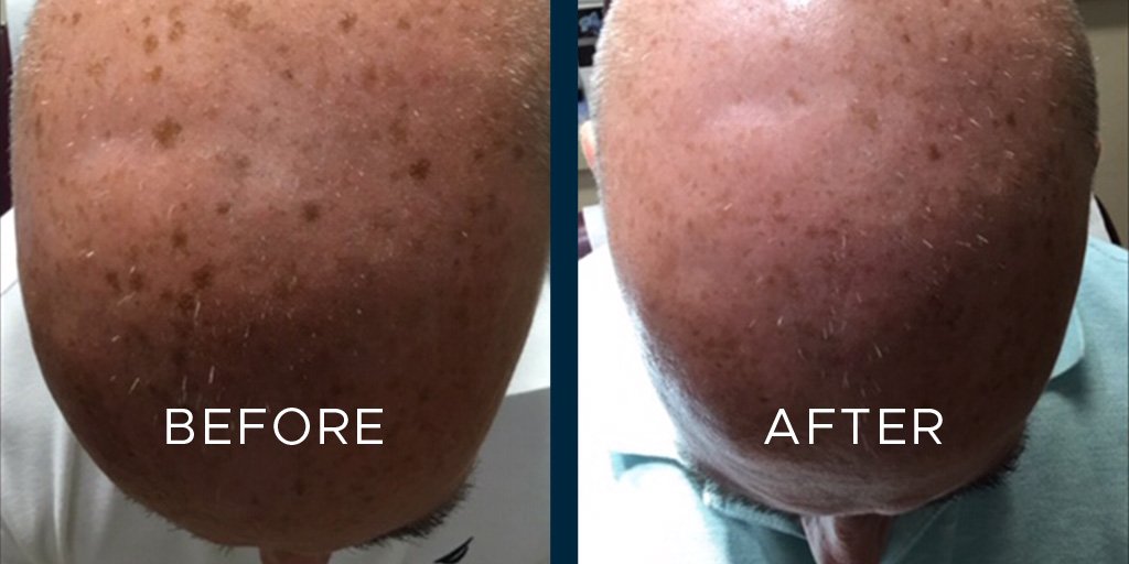 thedermgroup's tweet photo. Pigmentation reduction after one treatment by The Derm Groups Cindy Li, DO using the powerfully Versatile Pico Laser Technology.

1-3 treatments may be needed.

Request your appointment at: https://t.co/60NhAlr5uX or call
973.571.2121 https://t.co/5aGzVVlONr