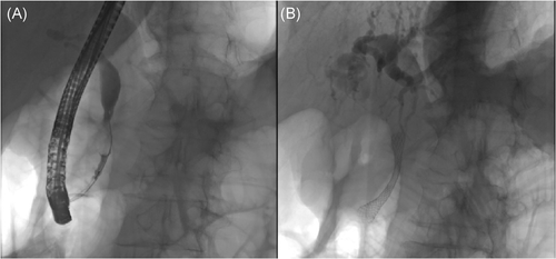 Abdul Aadam, MD, and Kevin Liu, MD, discuss strategies of endoscopic palliation of malignant biliary obstruction can differ based on sites and the degree of biliary obstruction with complex decisions of optimal stent type and more:
bit.ly/2rfjyaM