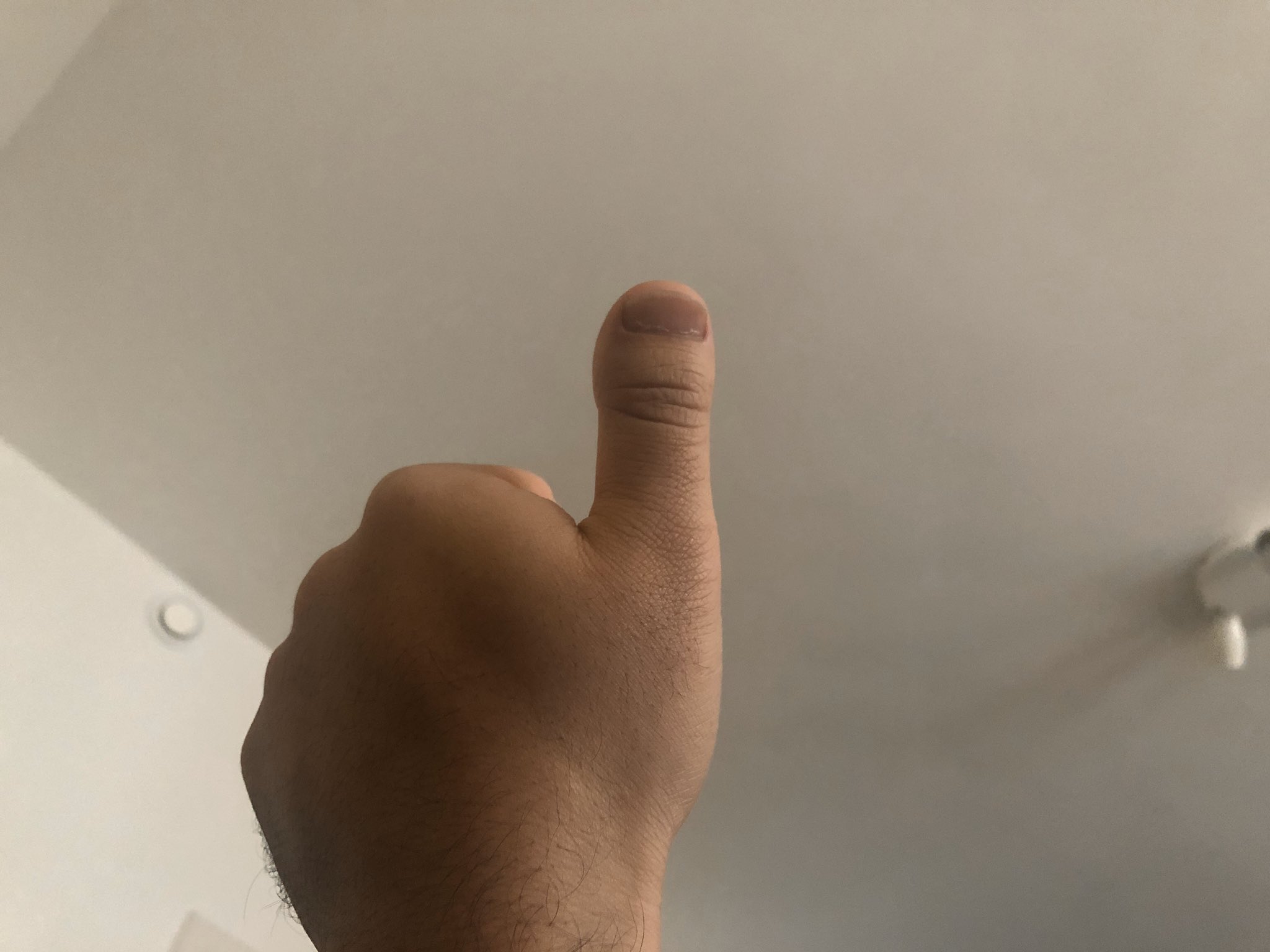 短指症 親指 確率
