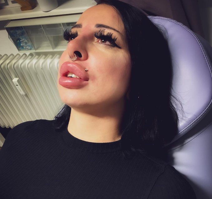 &bdquo;WERBUNG&ldquo; 2 days ago i pumped my lips up again @ MedicalThree Berlin. The results are so amazing. I&lsquo;m<a href="/tag/sex"class="tags"><span>#sex</span></a><a href="/tag/porn"class="tags"><span>#porn</span></a><a href="/tag/berlin"class="tags"><span>#berlin</span></a><a href="/tag/barbie"class="tags"><span>#barbie</span></a><a href="/tag/addict"class="tags"><span>#addict</span></a><a href="/tag/fuck"class="tags"><span>#fuck</span></a><a href="/tag/anal"class="tags"><span>#anal</span></a>