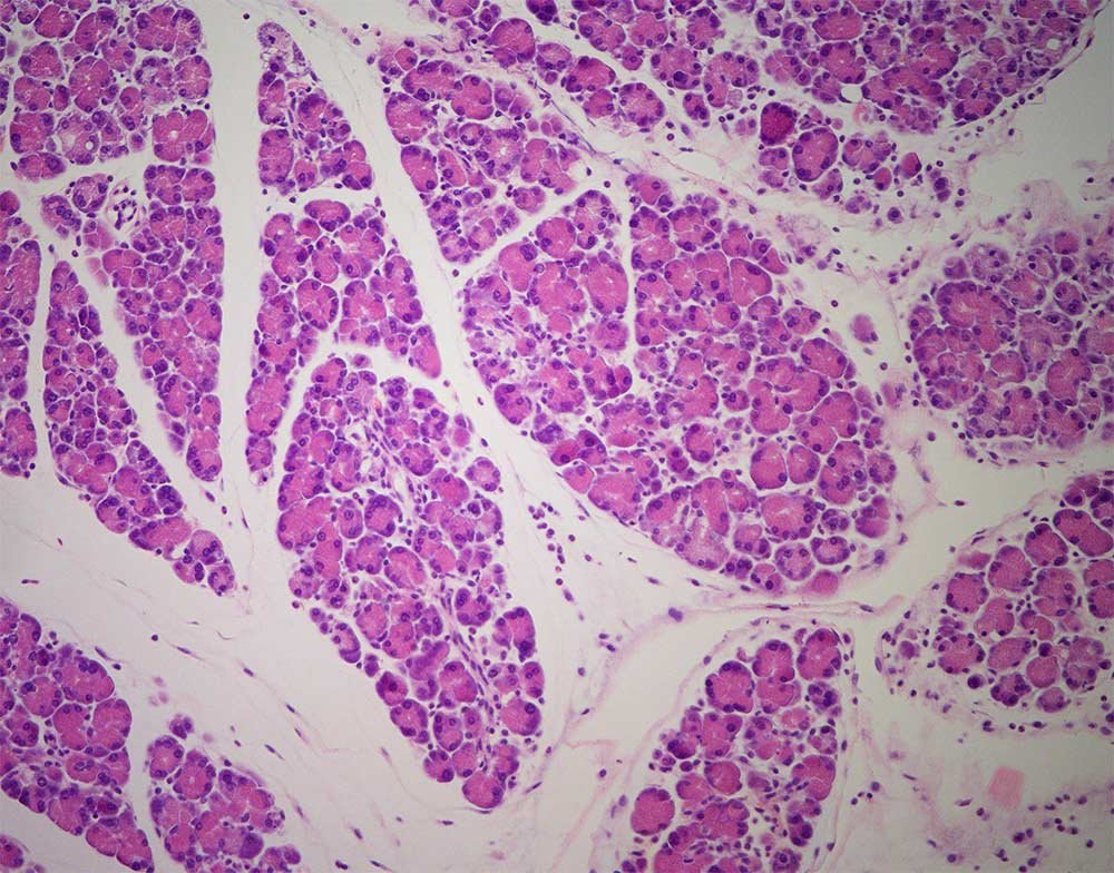 #DíaMundialCáncerPáncreas #CáncerPáncreas 

El cáncer de páncreas es el 9º en frecuencia y la 3ª causa de muerte por cáncer en España, donde se estima que se diagnosticarán más de 7.500 casos nuevos al año. Poder dar un giro a estas cifras pasa por la investigación.

Hilo 👇