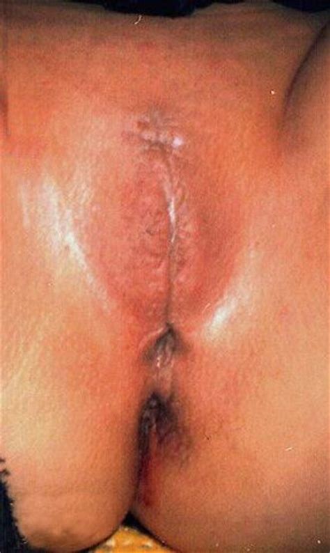 Ps THIS IS MUTILATION.Removal of foreskin does not intend to cause sexual d...