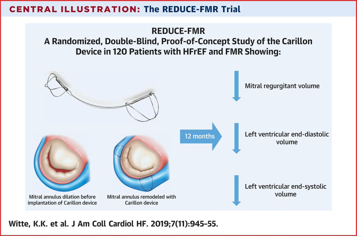 Does a coronary sinus-based mitral annular reduction strategy reduce functional #vhdMR in symptomatic #heartfailure patients on #GDMT? Learn with findings from the REDUCE FMR Trial in #JACCHF. bit.ly/2QFZRE7