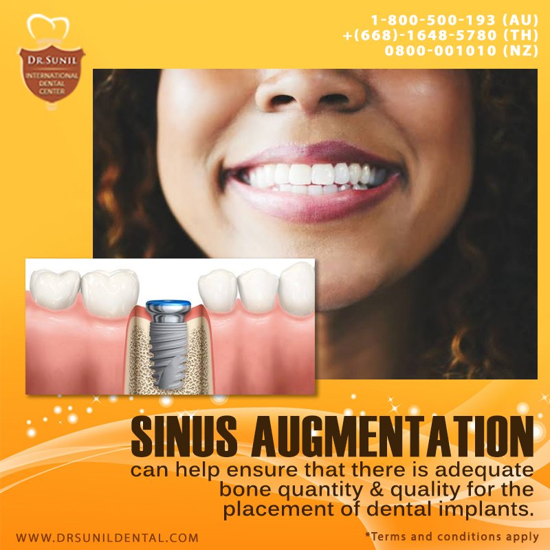 drsunilphol's tweet image. #SinusAugmentation #SinusLift #DentalImplants #DentalTreatment #DrSunil #BangkokDiscoverYourSmile #DrSunilDentalClinic #DentalHoliday #DentalPackage

Visit: drsunildental.com
Call us on: + (66)-81648-5780.
WhatsApp No: +66816485780
Email: info@drsunildental.com