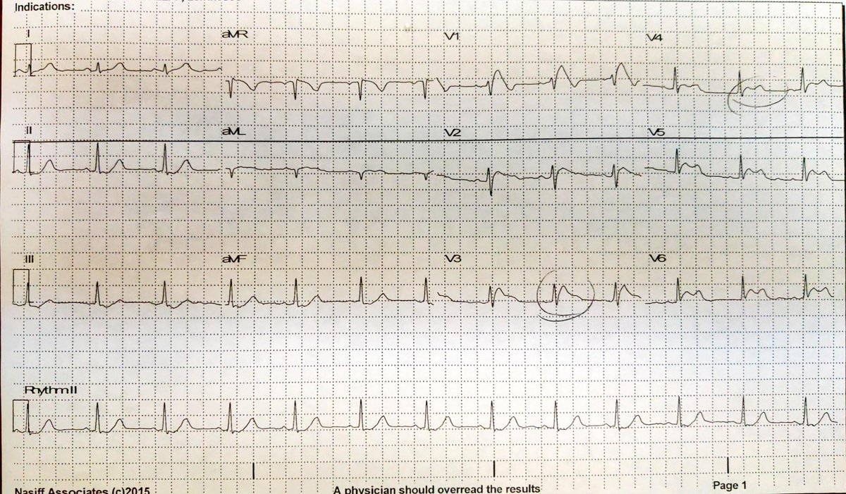 Has anyone <a href="/EPeeps/">e__peeps</a> seen this kind of pattern before? 48 female from India with no family history and this EKG on routine visit.