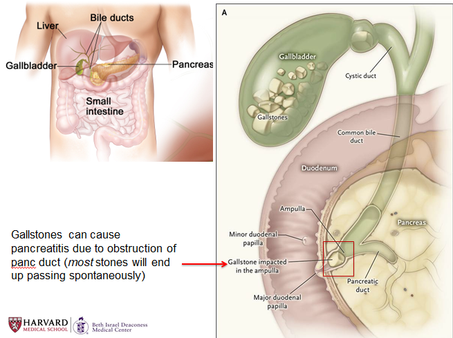 tberzin's tweet photo. 2 thoughts from #pancreatitis lecture @mit_hst @harvardmed:
1) @mit_hst students= tough crowd, in *best* possible way. Fearless & thoughtful Q's. Changes how I think about #pancreatitis every time.
2) A++: course leaders are two leading #WomeninGI @SarahFlierMD & #AnnaRutherford https://t.co/sPIBN5W7xA