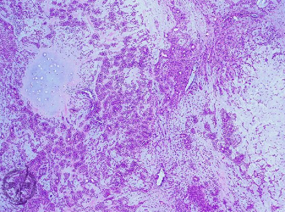 医師国家試験クイズくん 摘出した耳下腺腫瘍の病理標本とh E染色標本 弱拡大 強拡大 とを別に示す 画像は病理コア画像より引用