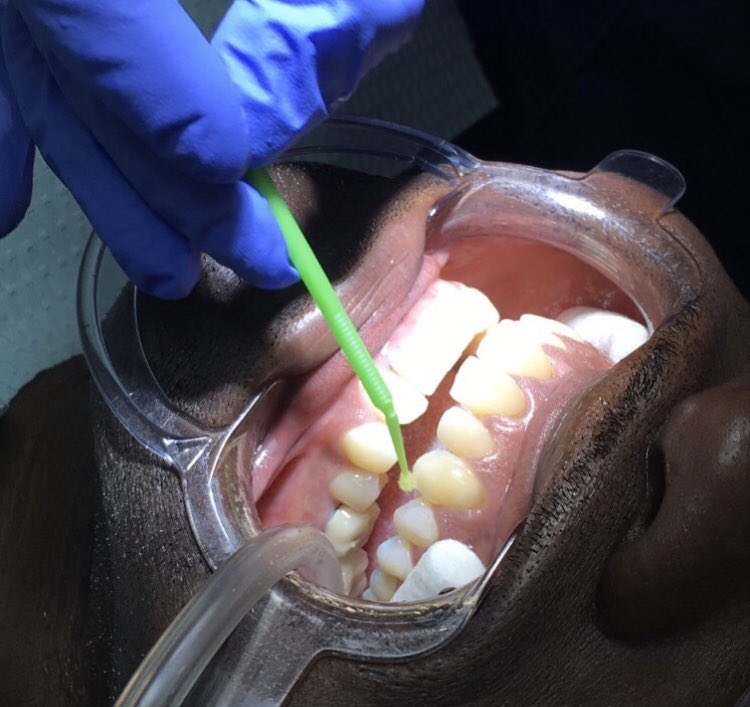 ArguelloDr's tweet photo. Invisalign is often advertised as being pain-less and less painful than metal braces. But that doesn't mean that Invisalign doesn't hurt. ... Putting pressure on the teeth means some discomfort and pain. This can be pronounced during the first few days https://t.co/y3D1WqjTfd