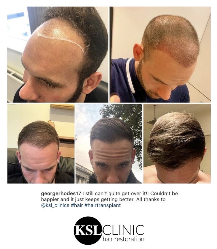 Dr Matee Hair Restoration Drmateeofficial Twitter