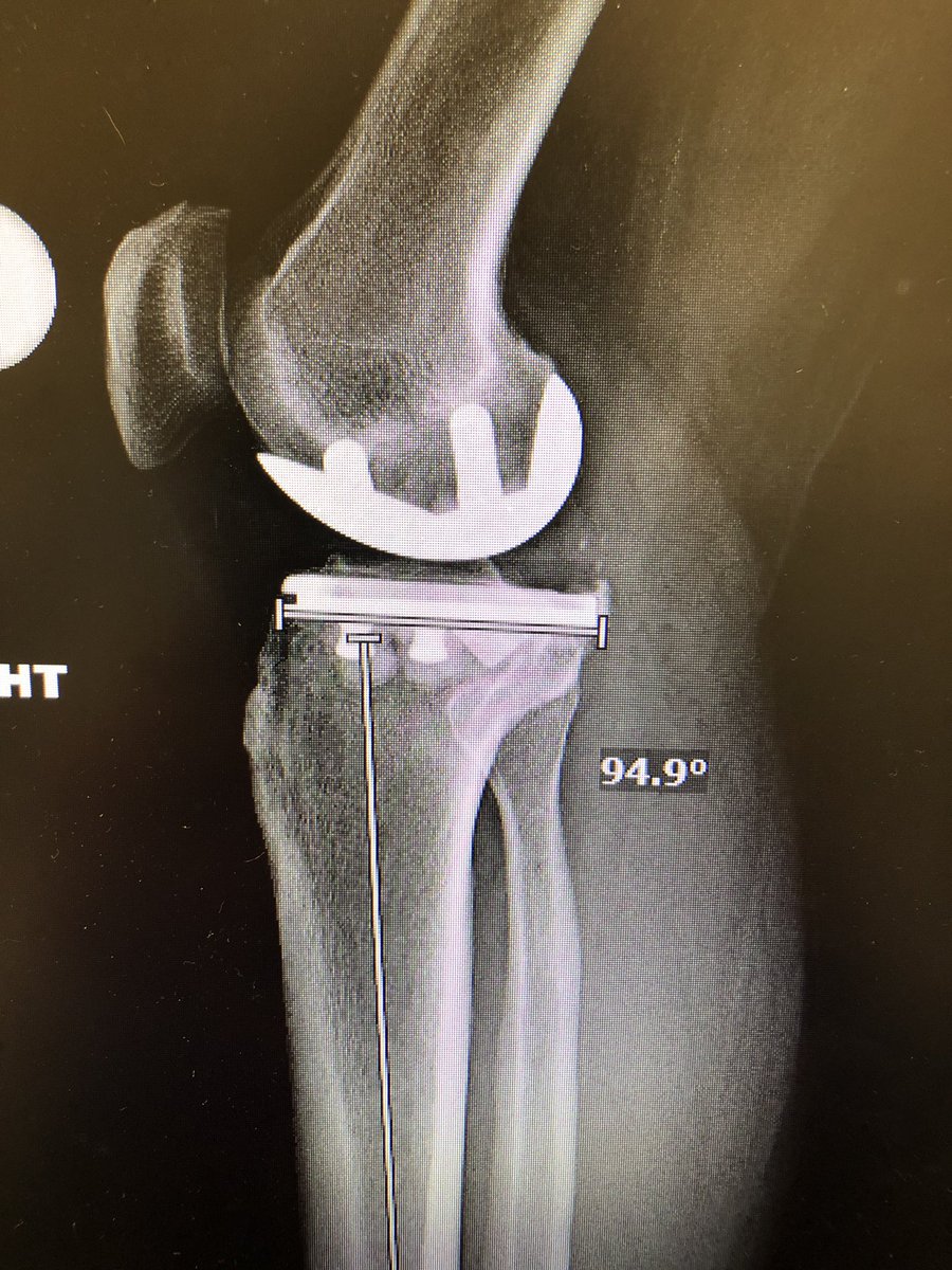 I love   #UKA. Here is a 2 year XR on patient with focal medial knee OA, ROM 0-136, no pain, loving the new partial   #KneeReplacement. Targets are 90 on AP, 5 of slope on Lateral. Not sure how   #Robotics can make this much better!!