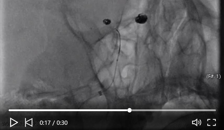 PerflowM's tweet photo. Dr. Guido Trasimeni, Neuroradiologist Doctor at the University of Rome "La Sapienza", presented a very interesting case and use of the Cascade Non-Occlusive Remodeling Net. Perflow Medical's products are not available for sale in the USA
#neurovascular
https://t.co/uJvowLFCbx https://t.co/ffWa9QAiAA