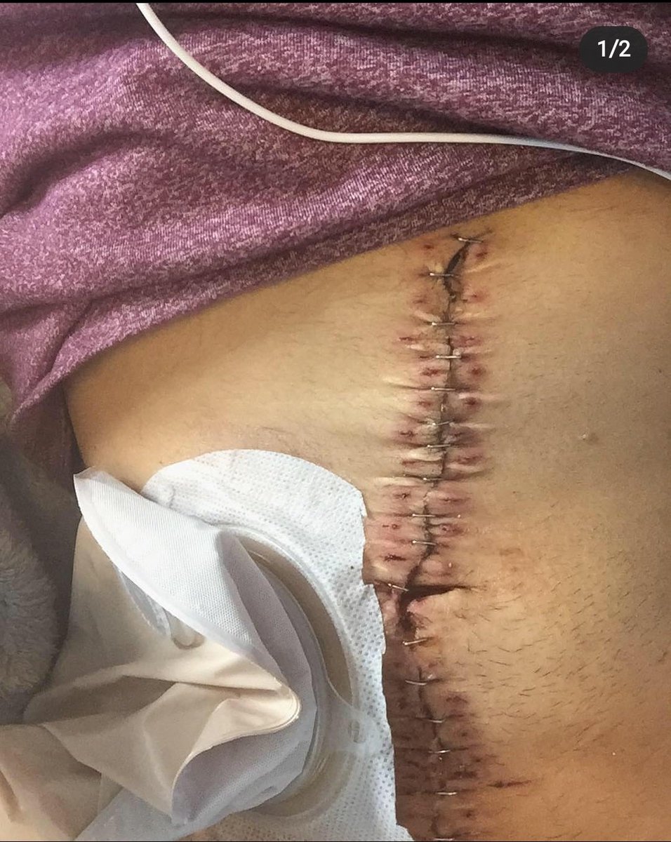 I cried and begged for another option and she told me she could do a double fistulectomy on me but it would mutilate my vaginal area pretty bad. At this point, I didn't care. I said go ahead. If you're wondering what an ileostomy looks like (not my photo):