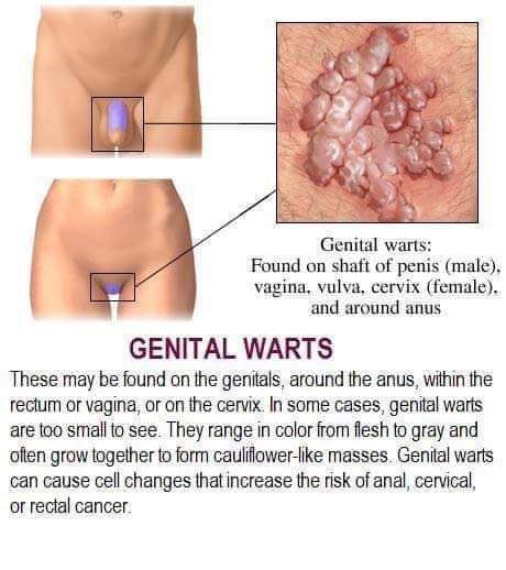 nhs hpv genital warts squamous papilloma uvula pathology outlines