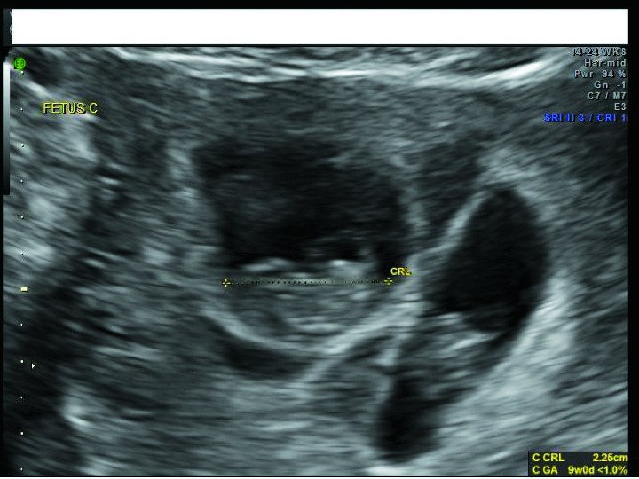 ContempOBGYN's tweet photo. Early imaging is key to the diagnosis of the many #anomalies that are unique to #multifetal gestations. The third #slideshow of our #ultrasound collection includes examples of these anomalies.
https://t.co/gvk1rtnL05 https://t.co/PSnRaMynVZ