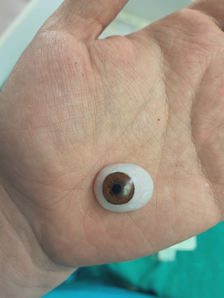 cristrubilar's tweet photo. #EnChileNosDejanCiegos TODA persona que haya sufrido una #estallidoocular se pueden realizar #protesisocular yo las hago 100% sin costo en #hospitalsoterodelrio ademas existen otras instituciones de gran experiencia porfavor ayudame con tu #RT en apoyo a Gustavo Gatica 🙏 https://t.co/b1X2PkR3vo