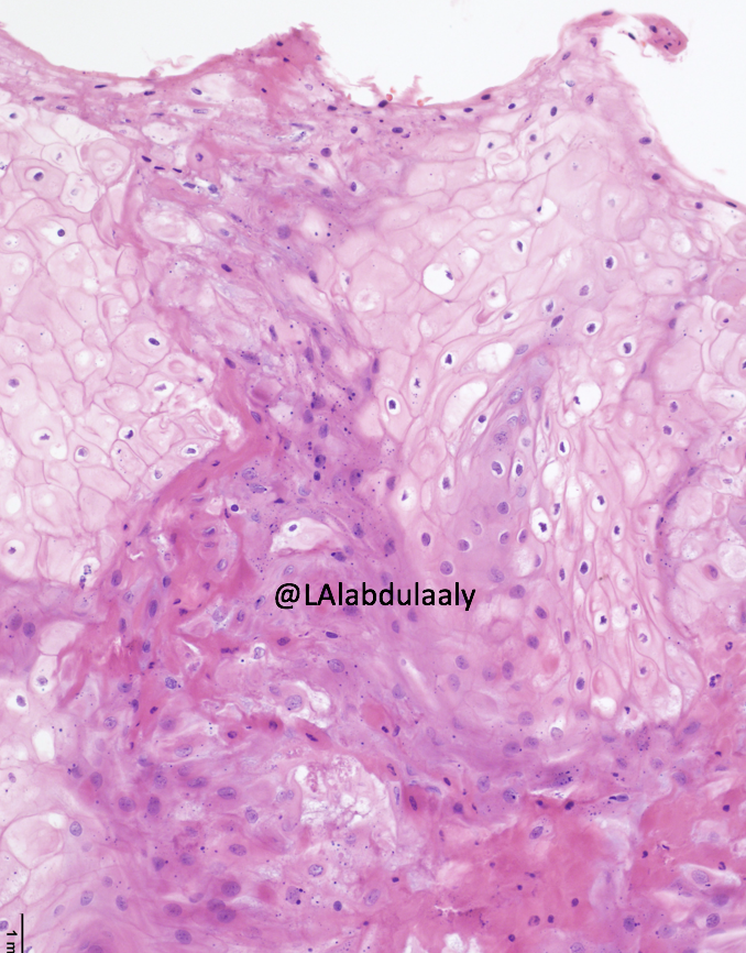 Hi all 👋🏻
This is a 17-year-old male with a white lesion on the buccal mucosa.
Please excuse the artifacts 🙊