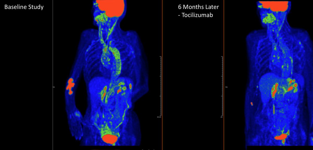 Peter Grayson (@petercgrayson) on Twitter photo <a href="/zach_wallace_md/">Zach Wallace</a> <a href="/MGHMedicine/">MassGeneral Medicine</a> @MGH_RI <a href="/jrheum/">The Journal of Rheumatology</a> Mild flare in patient with GCA and associated PET activity treated with toci mono therapy with clinical improvement and resolution of vascular inflammation. <a href="/zach_wallace_md/">Zach Wallace</a> <a href="/MGHMedicine/">MassGeneral Medicine</a> @MGH_RI <a href="/jrheum/">The Journal of Rheumatology</a> Mild flare in patient with GCA and associated PET activity treated with toci mono therapy with clinical improvement and resolution of vascular inflammation.
