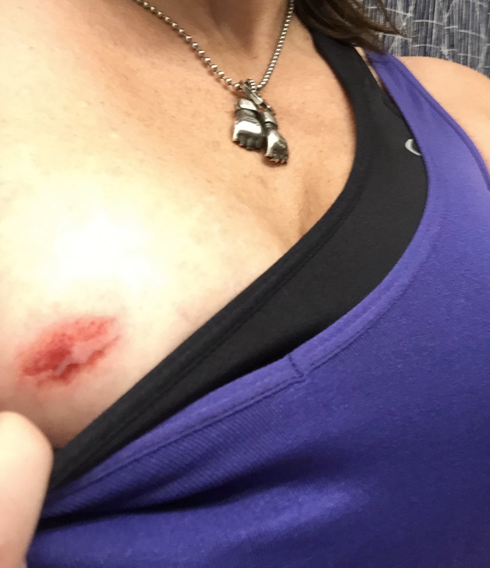 MrAndyNgo's tweet photo. .@TaraLaRosa says she was injured when the woman bit through her hoodie, shirt and bra. She has scrapes on her neck and knees as well. https://t.co/k1nJCpDCdi