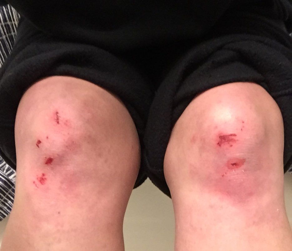 MrAndyNgo's tweet photo. .@TaraLaRosa says she was injured when the woman bit through her hoodie, shirt and bra. She has scrapes on her neck and knees as well. https://t.co/k1nJCpDCdi