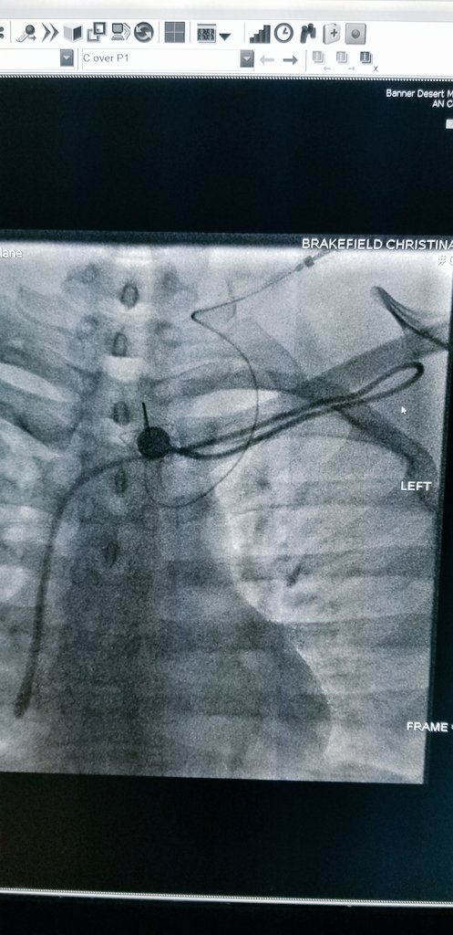 Shamit Desai On Twitter Subclavian Ports Still Running Rampant