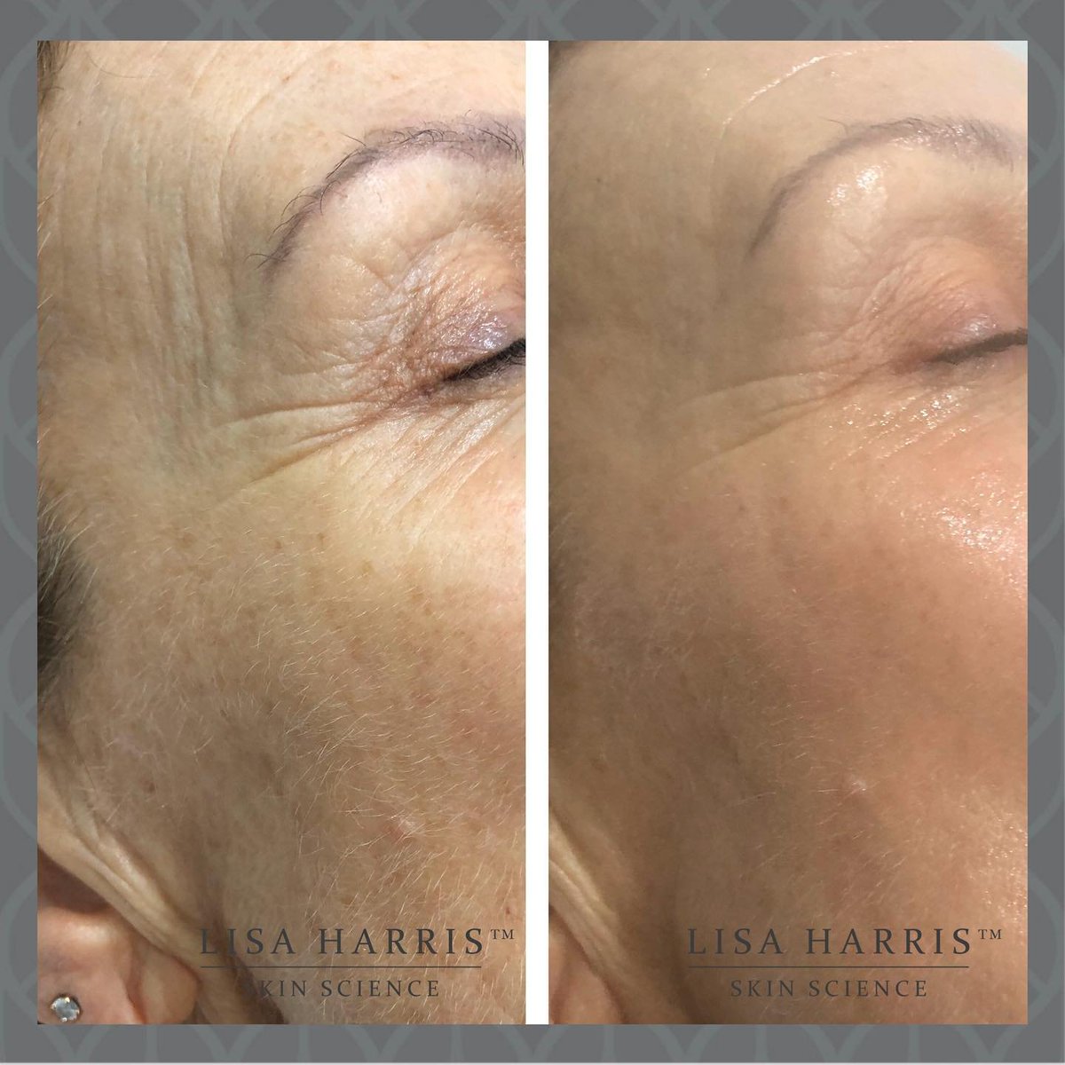 LisaHarrisSkin's tweet photo. Before &amp; After the incredible Cool Laser treatment starts Lisa Harris Skin Science . Completely transforming your skin for a much more youthful , healthy complexion! 

#10yearsyounger #coollaser #laserskintreatment #pigmentation #realresults #beforeandafter #transformation https://t.co/QUy02SwURg