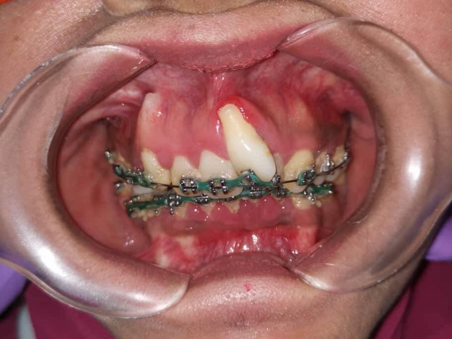 Nasihat dari seorang Dentist untuk yang pakai fake braces.
