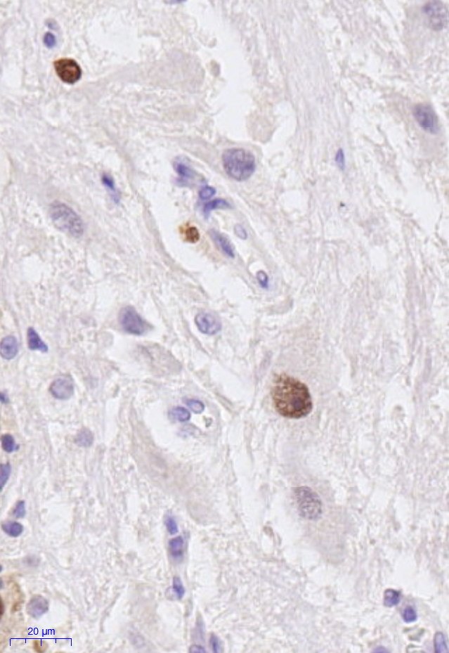 Mixed gangliocytoma-pituitary adenoma: Ganglion cells are believed to result from transdifferentiation of adenoma cells - a concept supported by partial expression of anterior pituitary (GH/PRL lineage) transcription factor PIT1 in ganglion cells #neuropath #pituitary