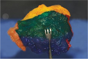 VectorSurgical's tweet photo. The @UMNSurgOnc study found that “intraoperative inked specimens provide a more accurate 3-dimensional location of the true positive margin.” #positivemargin #MarginMarker @AltmanAriella @JHuiMD https://t.co/Vm3SxTSjjq https://t.co/aa0pTnzOOY