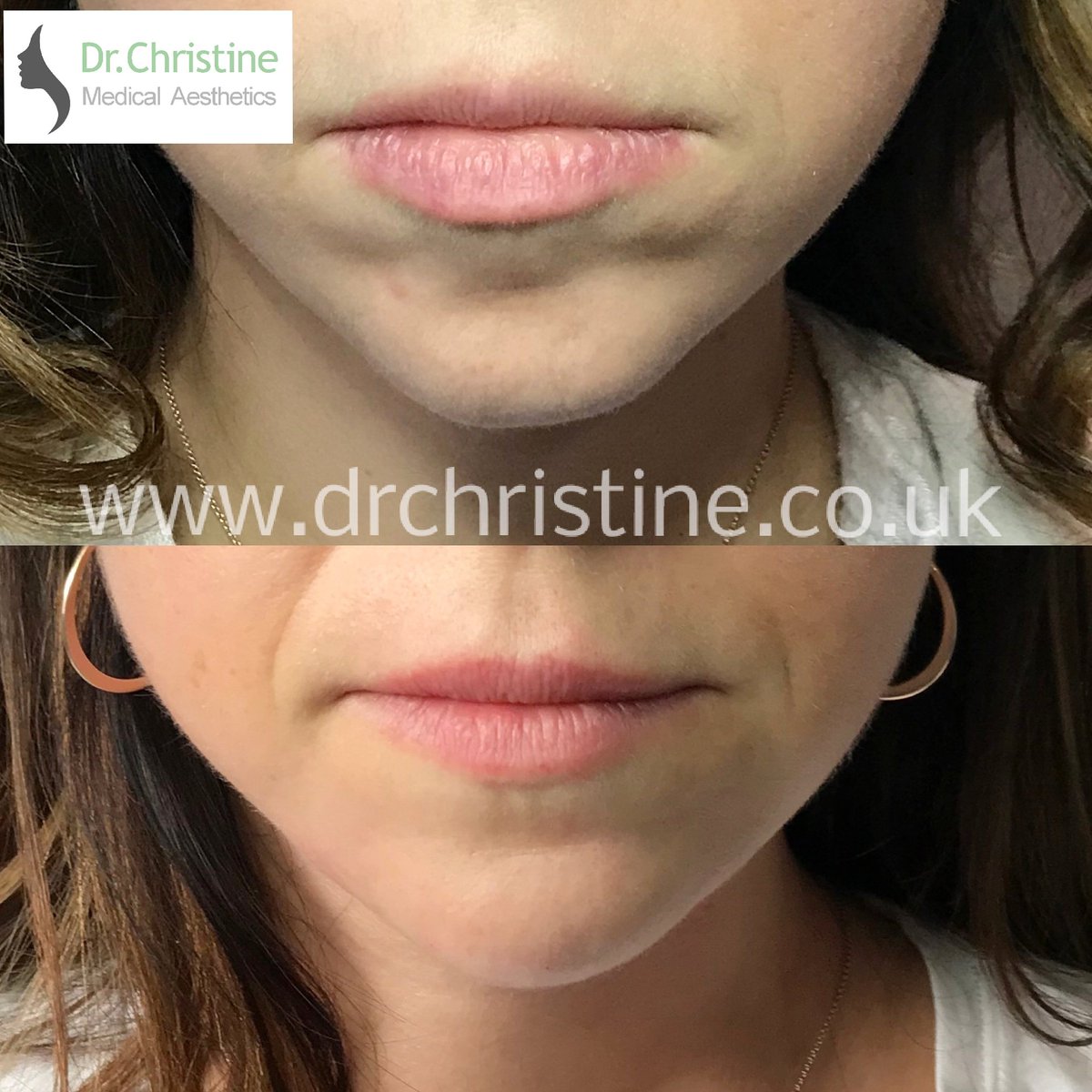 drchristine8's tweet photo. Before and After of my beautiful client.
Dermal filler Juvederm Volux was used to create a more symmetrical and blended chin, using a combination of needle and cannula techniques.
#beforeandafter #juvederm #fillers #facialharmony #tunbridgewells https://t.co/4fQfojemNE https://t.co/E6kmMDHafb