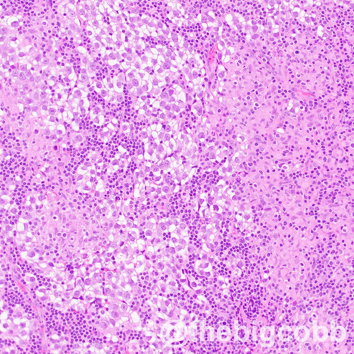 Pineal mass in an 18 year-old male. Very classic case!  #neuropath #pathology