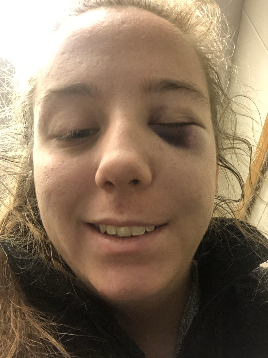 Codief14's tweet image. Like a big dumb idiot I broke two bones in my face. I can’t open my eye or my left side of my mouth all the way. I look like I’m having a stroke. I’m out here really living my best life.