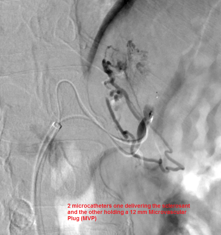NshRadiology's tweet photo. Isolated #Gastric #Varices in a #LiverCirrhosis patient. Managed by #Balloon #Occlusion #Retrograde #Transvenous Obliteration (#BRTO). Supposed to use an occlusion balloon but this time we used a #MicrovascularPlug #MVP to avoid an overnight hospital stay ... #IRad #Radiology https://t.co/yIZKgMWPZa