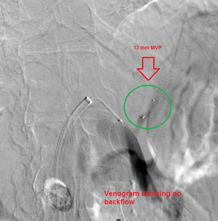 NshRadiology's tweet photo. Isolated #Gastric #Varices in a #LiverCirrhosis patient. Managed by #Balloon #Occlusion #Retrograde #Transvenous Obliteration (#BRTO). Supposed to use an occlusion balloon but this time we used a #MicrovascularPlug #MVP to avoid an overnight hospital stay ... #IRad #Radiology https://t.co/yIZKgMWPZa