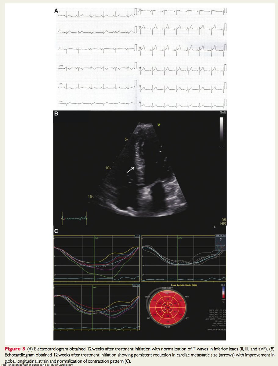 ESC_Journals's tweet image. UFOs (unidentified floating objects) in the heart - find out what they were and how they were treated here: bit.ly/2NpyOuJ

@johncamm #openaccess #EHJCaseReports #ESCCoT #ESCardioEd #CardioTwitter #echocardiography #immunotherapy #EchoFirst #WhyCT #WhyCMR @ggoliasch