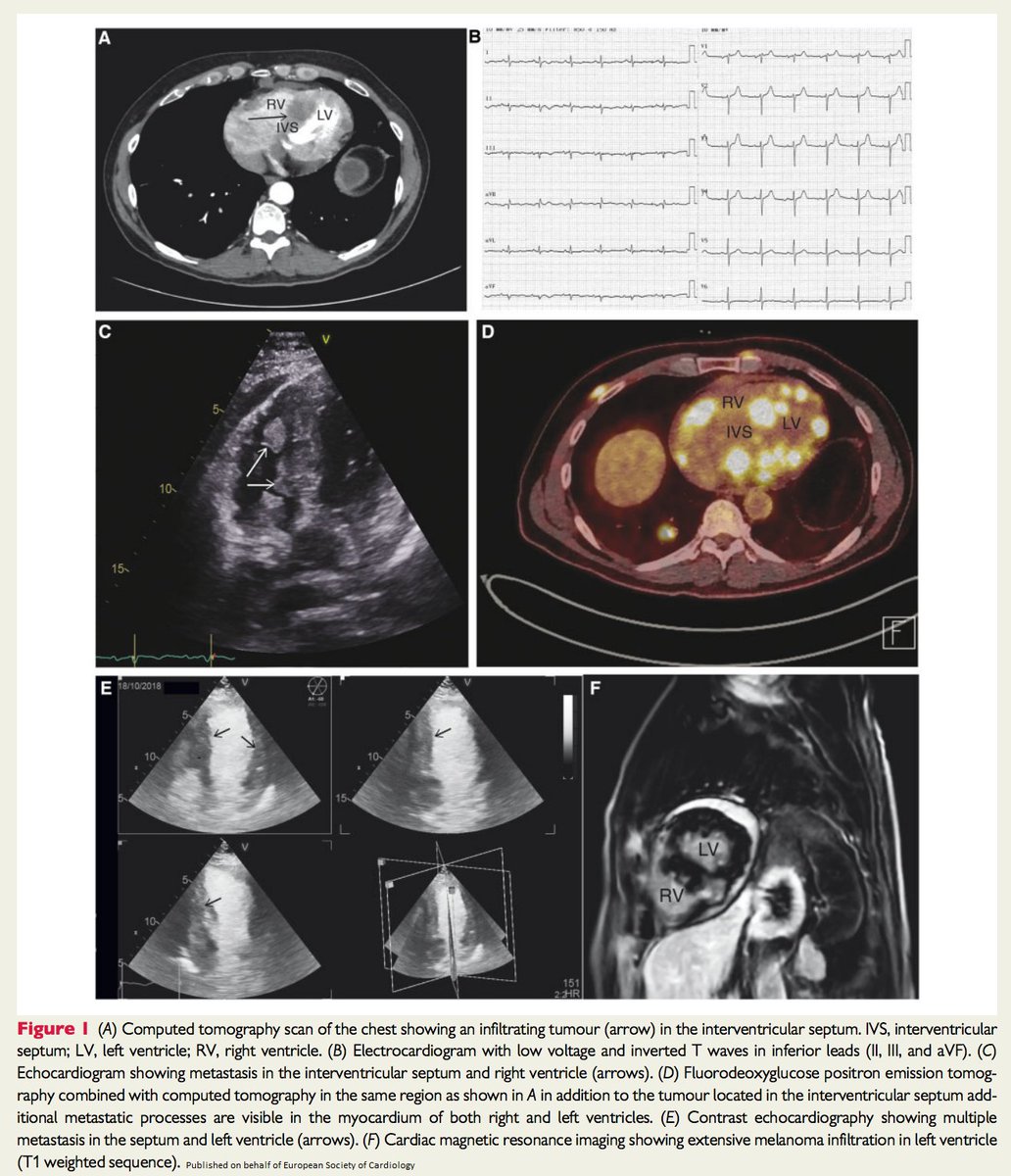 ESC_Journals's tweet image. UFOs (unidentified floating objects) in the heart - find out what they were and how they were treated here: bit.ly/2NpyOuJ

@johncamm #openaccess #EHJCaseReports #ESCCoT #ESCardioEd #CardioTwitter #echocardiography #immunotherapy #EchoFirst #WhyCT #WhyCMR @ggoliasch