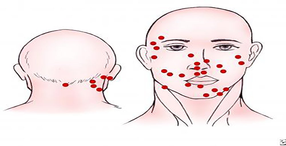 Medscape's tweet photo. New treatment guidance in our clinical tool on Merkel Cell Carcinoma and Rare Appendageal Tumors. #Cancer #MedUpdate https://t.co/AjKksnC4Bb #mccsm https://t.co/pKsHiEwLTp